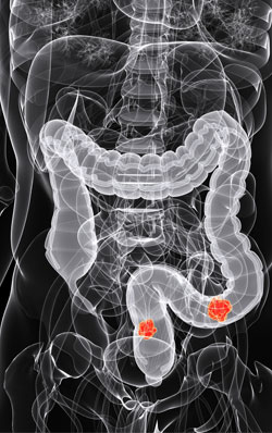 warning-signs-for-colon-cancer
